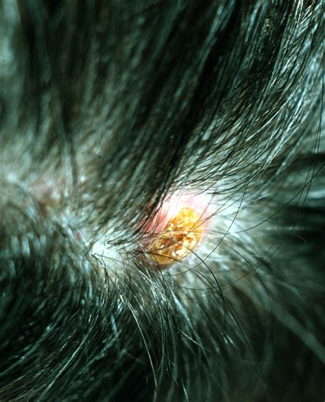 proliferating trichilemmal cyst.